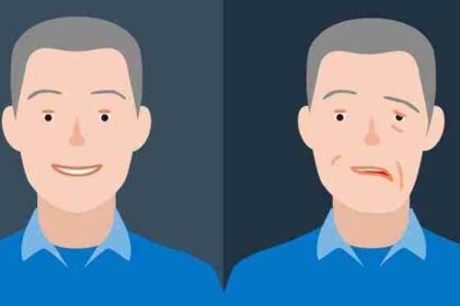 πάρεση του προσωπικού νεύρου