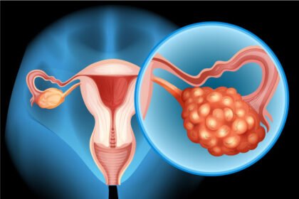 Σύνδρομο Πολυκυστικών Ωοθηκών (ΣΠΩ)