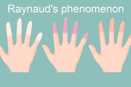 Φαινόμενο Raynaud