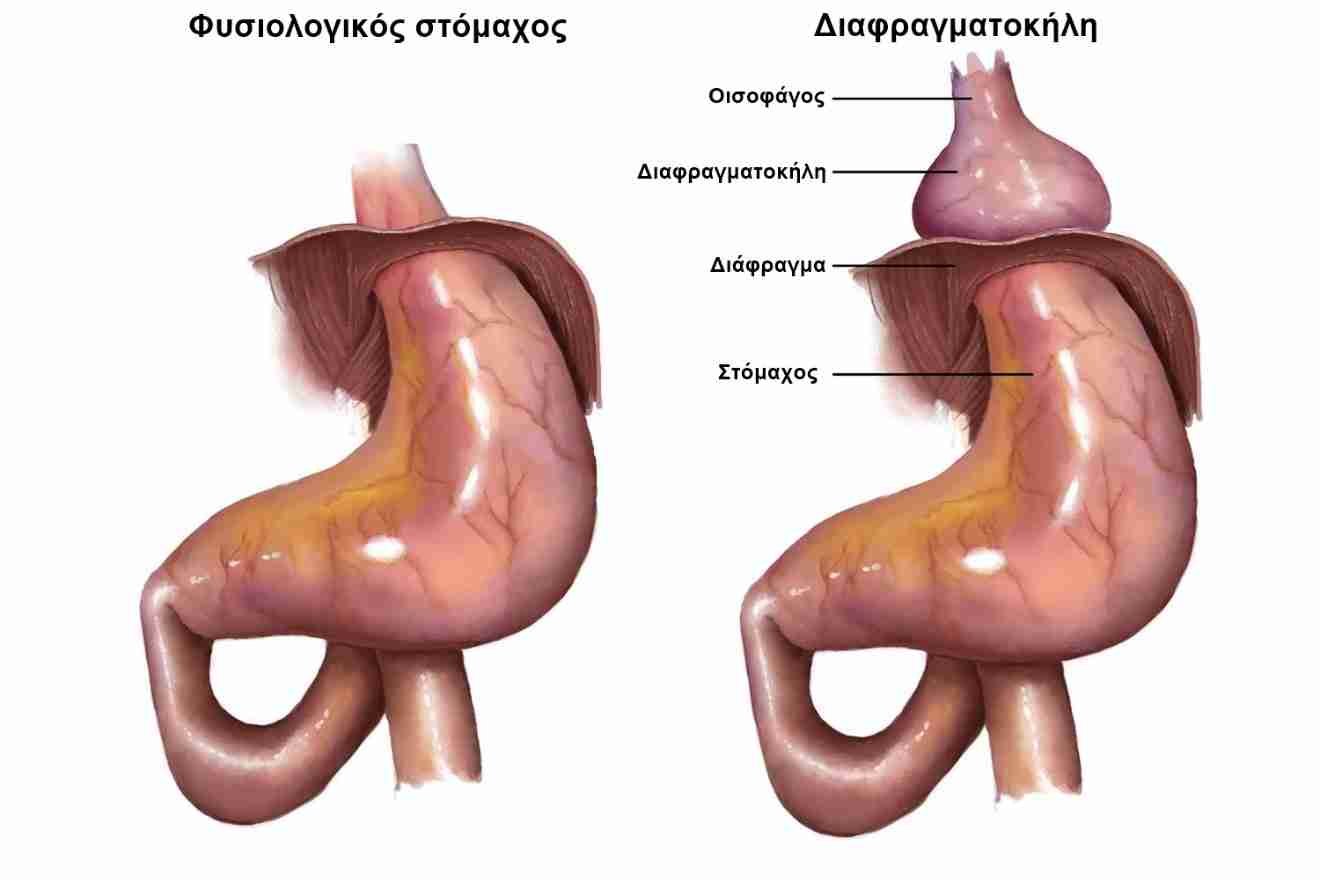  Διαφραγματοκήλη Συμπτώματα