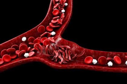 Δρεπανοκυτταρική Νόσος