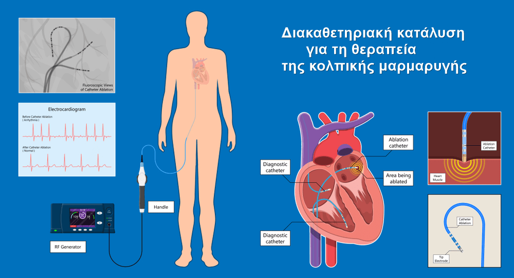 Κολπική Μαρμαρυγή: Συμπτώματα και αιτίες 15 kolp6