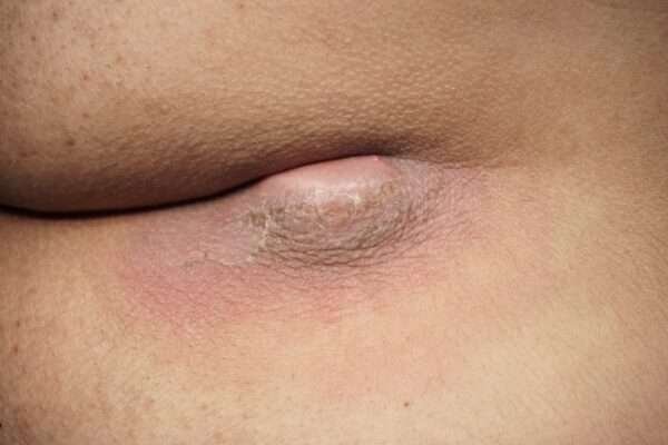 Κύστη κόκκυγος: Αιτίες, συμπτώματα, θεραπεία 25 κόκκυγος1 e1650900364803