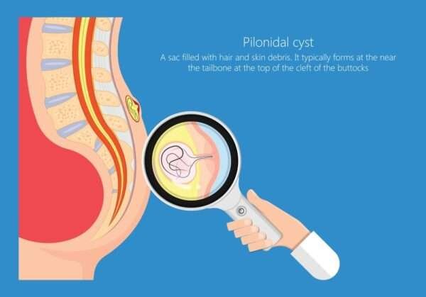 Κύστη κόκκυγος: Αιτίες, συμπτώματα, θεραπεία 26 κόκκυγος2 e1650900454523