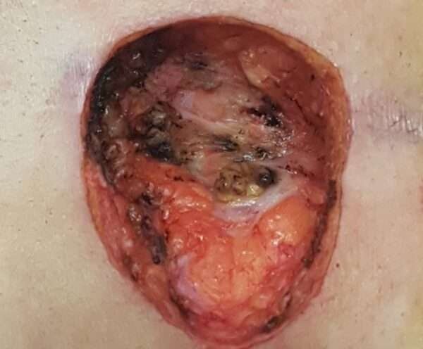 Κύστη κόκκυγος: Αιτίες, συμπτώματα, θεραπεία 27 κόκκυγος3 e1650900493312