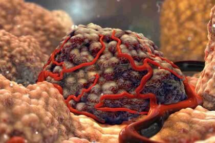 Καλοήθεις όγκοι μαλακών ιστών