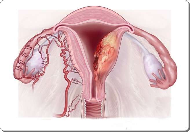 Καρκίνος του ενδομητρίου