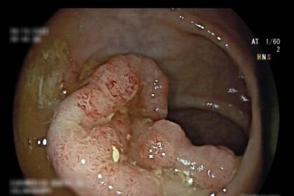 Πολύποδας εντέρου, 10 πράγματα που πρέπει να ξέρεις!