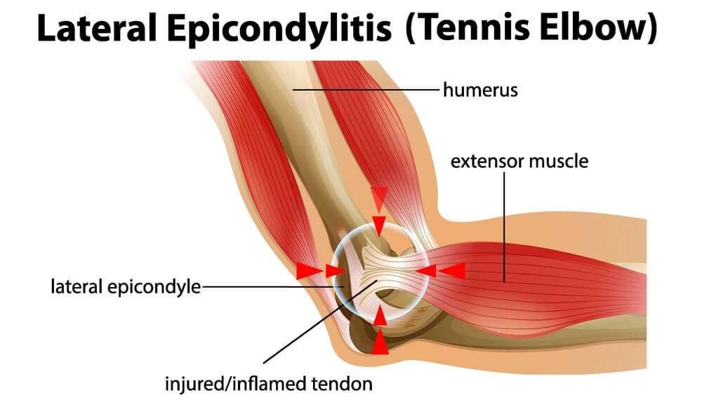 Tennis Elbow: Τι είναι ο αγκώνας του τενίστα ή αλλιώς η έξω επικονδυλίτιδα; 1 Αγκώνας του τενίστα