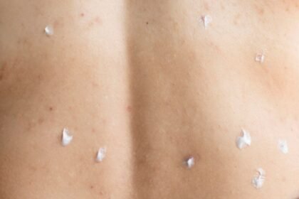 Φραγμένοι πόροι στο δέρμα