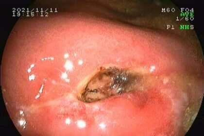 Έλκος στομάχου