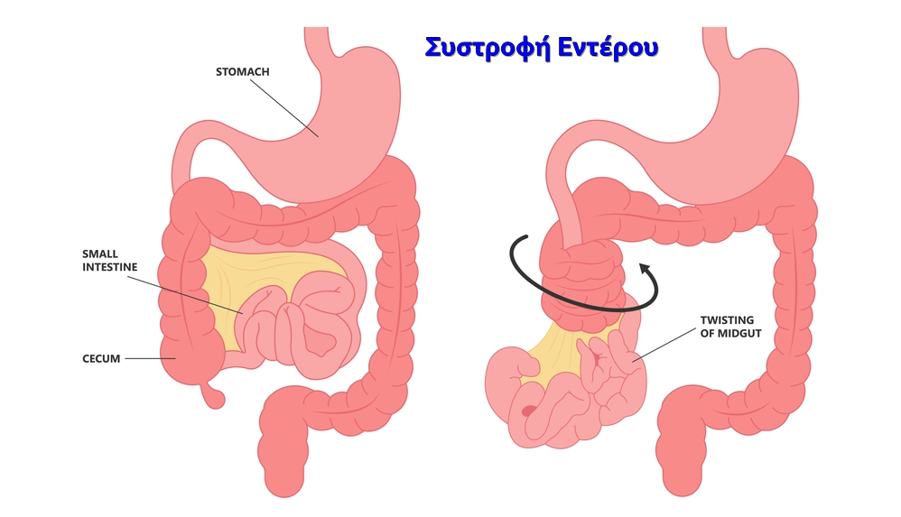 Οξεία Κοιλία: Αιτίες, διαχείριση 22 Οξεία Κοιλία