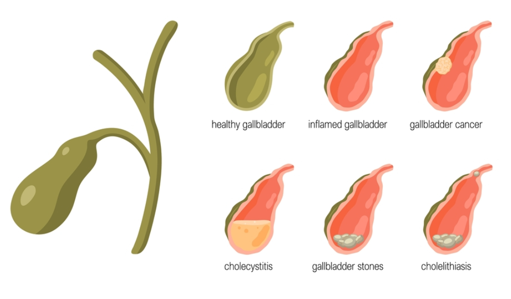 Τι είναι οι πολύποδες της χοληδόχου κύστης; Κινδυνεύουν να εξελιχθούν σε καρκίνο; 24 p3