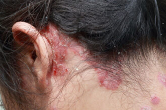 psoriasi