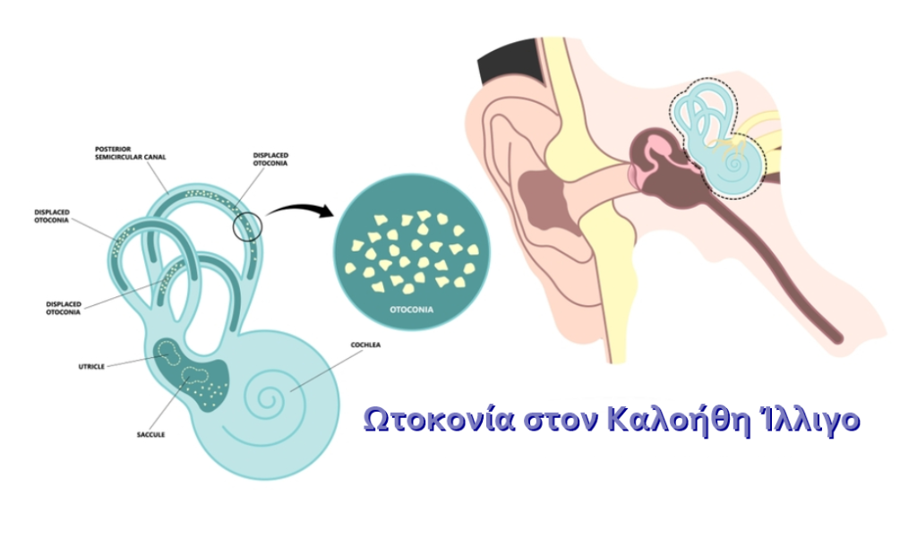 Πώς ξεχωρίζουμε τα διάφορα είδη ζάλης (ζαλάδες) 6 z2