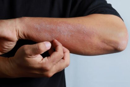 Σπιτικές και φυσικές θεραπείες για το έκζεμα