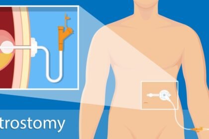 Διαδερμική ενδοσκοπική γαστροστομία