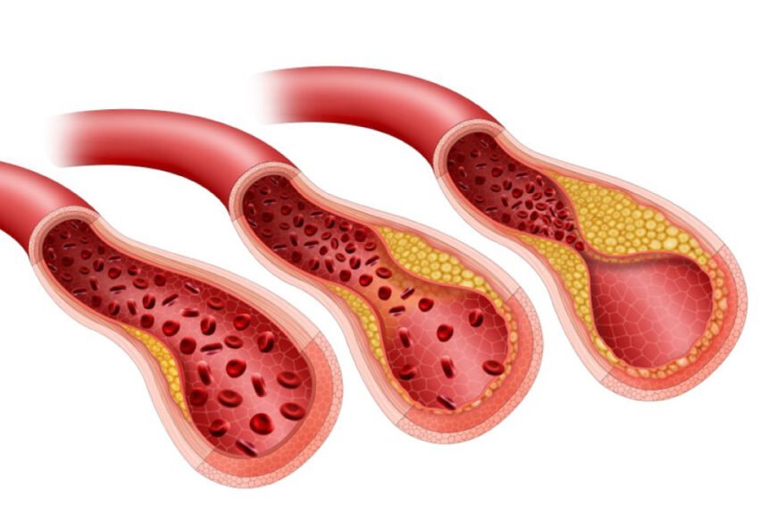 Αθηροσκλήρωση: Πόσο κινδυνεύουμε από την ύπουλη αυτή νόσο;