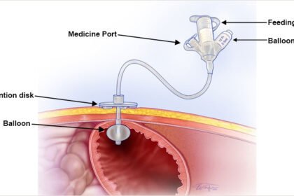 Γαστροστομία: Ερωτήσεις σχετικά με την τοποθέτηση του Σωλήνα σίτισης