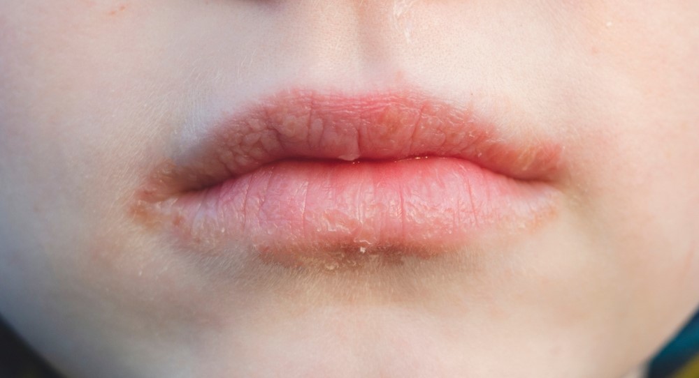 Τι μπορεί να σημαίνουν οι πληγές στα χείλη που δεν επουλώνονται; Τι είναι η Χειλίτιδα;