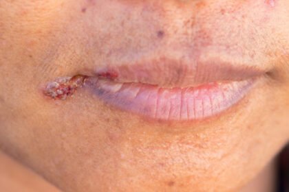 Τι μπορεί να σημαίνουν οι πληγές στα χείλη που δεν επουλώνονται; Τι είναι η Χειλίτιδα;