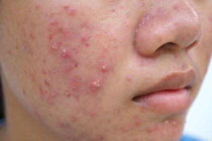 Πώς μπορούμε να καταπολεμήσουμε τα σημάδια της ακμής;