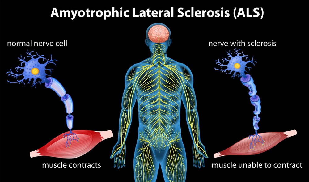 Πλάγια μυατροφική σκλήρυνση (ΠΜΣ) ή Νόσος του Κινητικού Νευρώνα