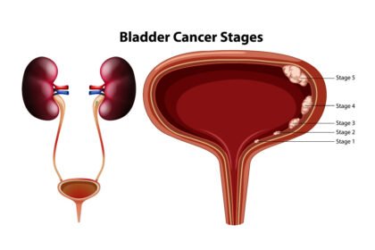 Καρκίνος της ουροδόχου κύστης: Ποια είναι τα συμπτώματα και πώς αντιμετωπίζεται;