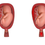 Premature placenta
