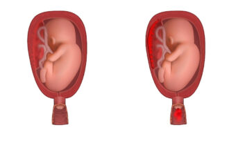 Premature placenta