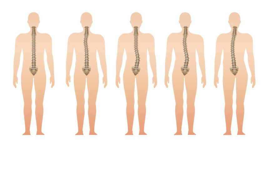 scoliosis