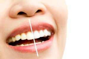 white teeth