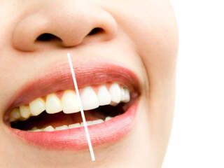 white teeth