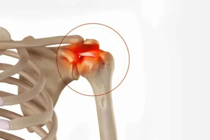 Όλα όσα πρέπει να γνωρίζετε για τις επασβεστώσεις