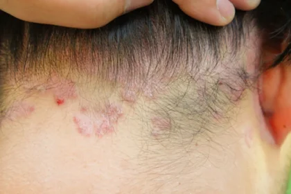 Πιθανές αιτίες κόκκινων κηλίδων στο τριχωτό της κεφαλής σας και πώς να τις αντιμετωπίσετε