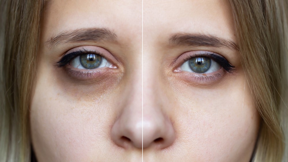 Μαύροι κύκλοι στα μάτια: Πώς να απαλλαγείτε