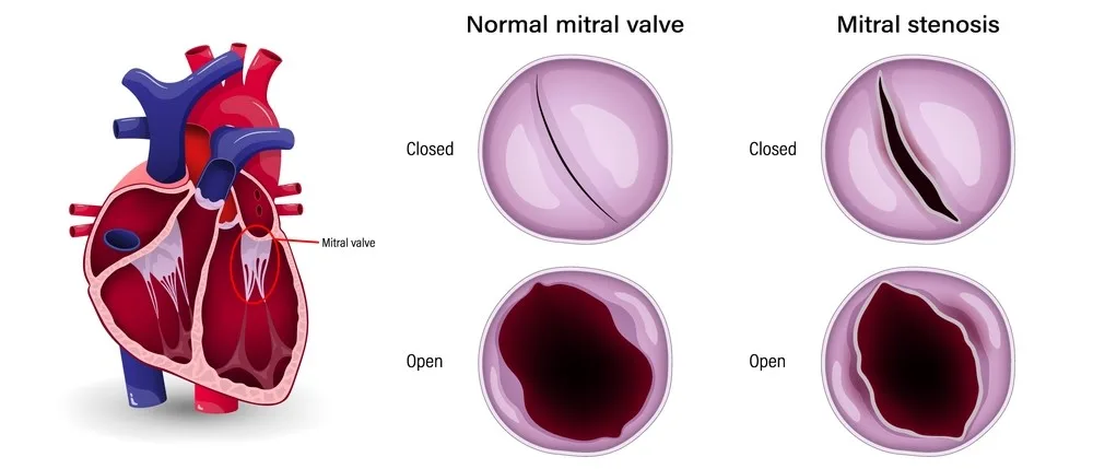 Στένωση της μιτροειδούς βαλβίδας