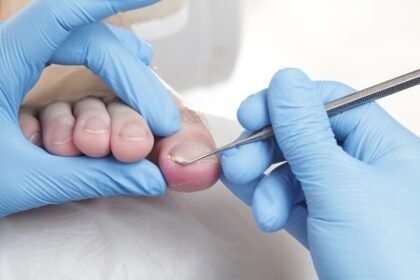 Είσφρηση του νυχιού. Όταν το νύχι στο μεγάλο δάχτυλο του ποδιού μας σφηνώνεται στη σάρκα μας