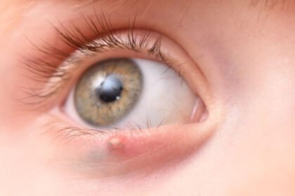 Μάθετε γιατί το σπάσιμο ενός κριθαρακίου στο μάτι μπορεί να προκαλέσει σοβαρά προβλήματα. Ανακαλύψτε συμβουλές για την ασφαλή αντιμετώπιση και αποφυγή επιπλοκών.