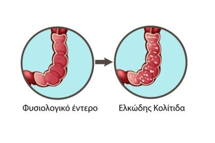 ελκωδης-κολιτιδα
