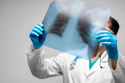 H Χρόνια Αποφρακτική Πνευμονοπάθεια (ΧΑΠ) είναι μία πάθηση που χαρακτηρίζεται από προοδευτική, μη αντιστρεπτή επιδείνωση της αναπνευστικής λειτουργίας, η οποία εκδηλώνεται με δύσπνοια, βήχα, απόχρεμψη και εκπνευστικό συριγμό.