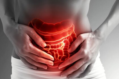 ulcerative colitis