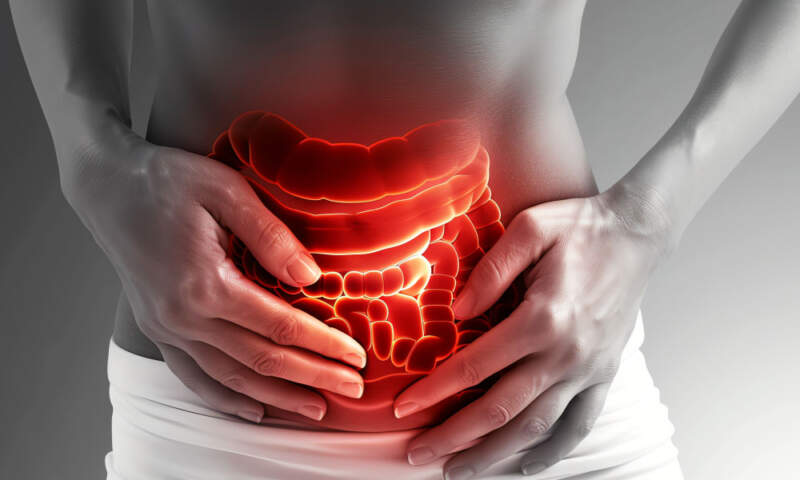 ulcerative colitis