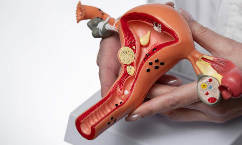 anovulation