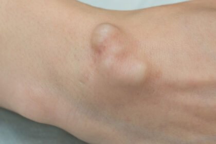 Μάθετε τι είναι οι επιδερμοειδείς κύστεις, ποιες είναι οι αιτίες τους, τα συμπτώματα που προκαλούν και ποιες είναι οι διαθέσιμες θεραπείες για την αντιμετώπισή τους.