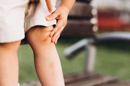 Η ραχίτιδα είναι μια παιδική ασθένεια κατά την οποία τα οστά του παιδιού σας είναι πολύ μαλακά, με αποτέλεσμα τα οστά του να παραμορφώνονται, να λυγίζουν και να σπάνε πιο εύκολα.