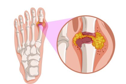 Τα συμπτώματα της ουρικής αρθρίτιδας σχετίζονται με την αντίστοιχη πάθηση, η οποία μπορεί να αναπτυχθεί όταν υπάρχει περίσσεια ουρικού οξέος στον οργανισμό.